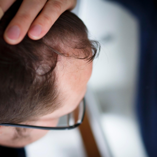 Oben ohne - Haarausfall bei Männern: "Du versuchst das zu vertuschen"