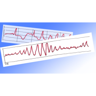 Torsade de pointes – perioperativ