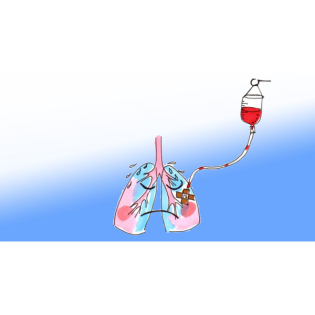 Transfusion und Lunge: TACO und TRALI