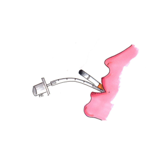 Präoperative Nüchternheit und Rauchen