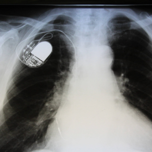 Hacker-Angriffe auf Herzschrittmacher: Wie real ist die Gefahr?