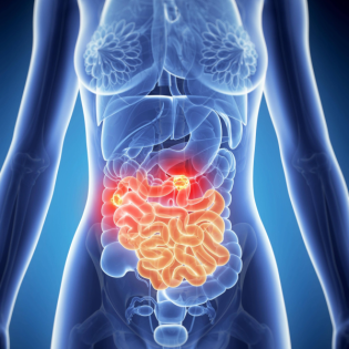 Was die Darmkrebsvorsorge wirklich bringt