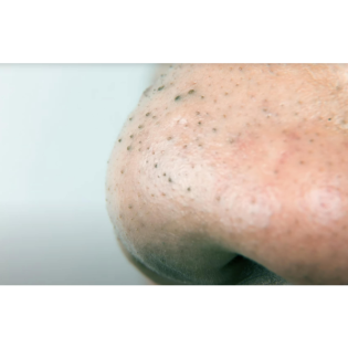 Mach genau DAS und werde die Mitesser auf deiner Nase los